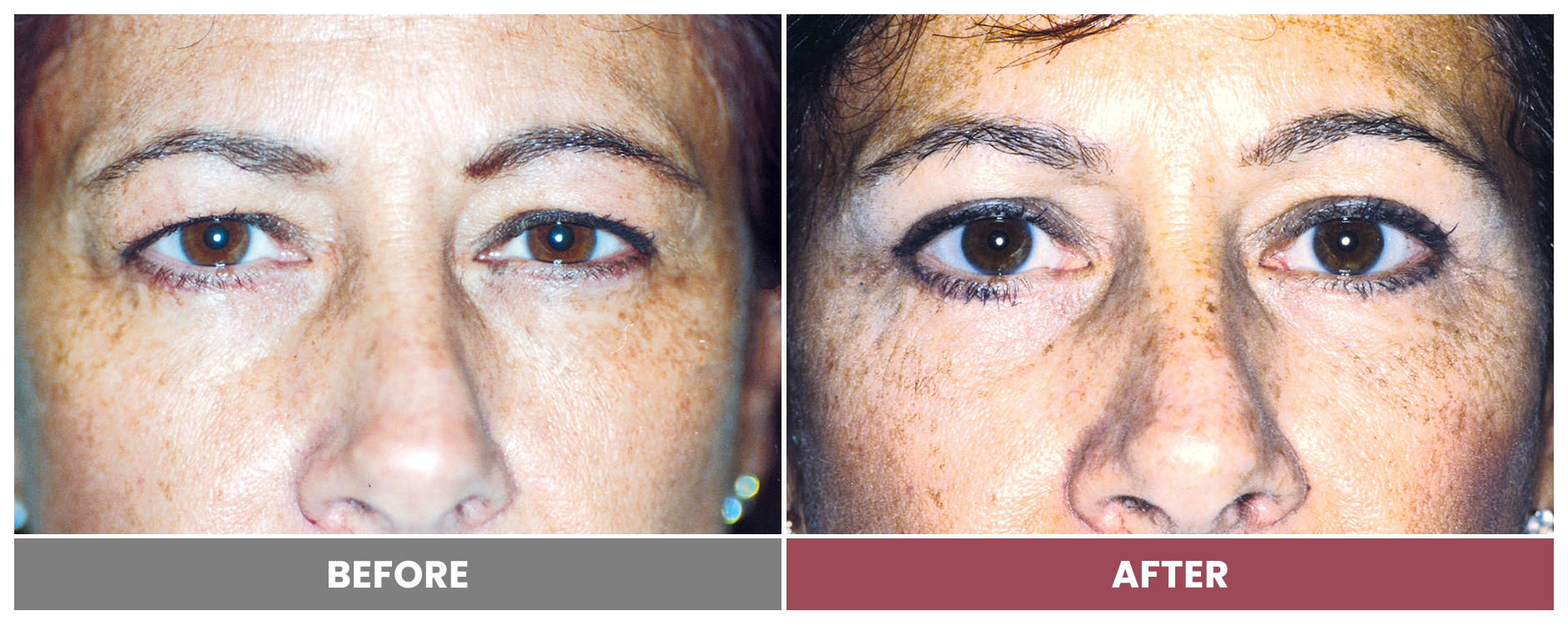 Upper Blepharoplasty - Case 18